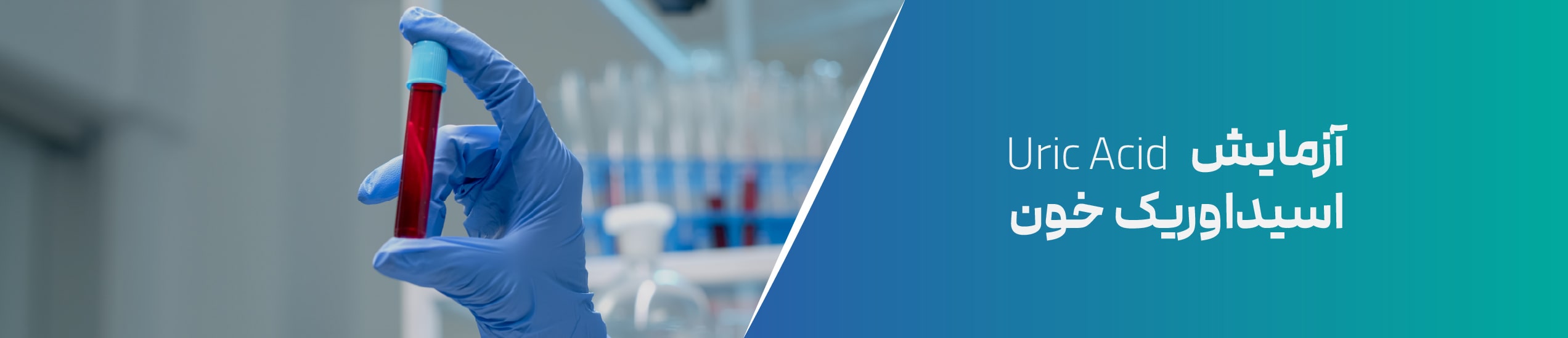 آزمایش اسید اوریک خون(Uric Acid)